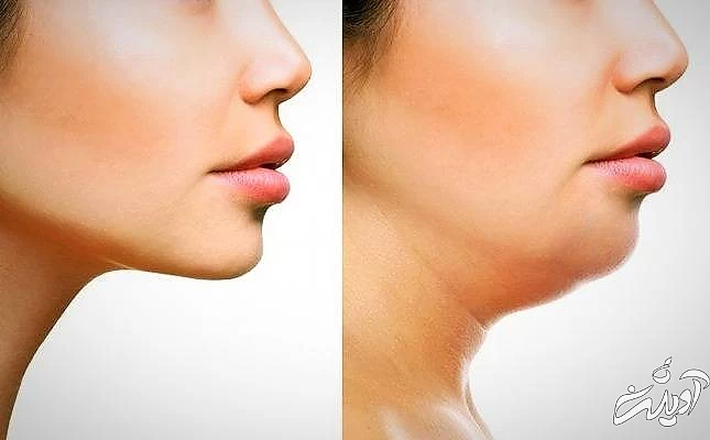 بهترین روش خانگی رفع غبغب عامل ایجاد غبغب